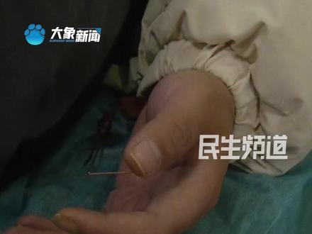 中医特种针法鬼门13针 针对13个穴位 不同穴位不同方法 看中医针灸如何治疗精神疾病