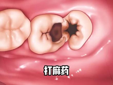 智齿拔除过程#智齿 #拔智齿 #牙齿 #拔牙 #一口好牙