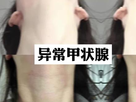 正常甲状腺与异常甲状腺