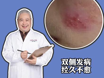 小伙子脸上长了#带状疱疹 ,没想到竟然是...#医学科普 #医学科普