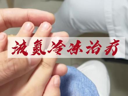 女儿手上长了瘊子,医院皮肤科液氮冷冻治疗,没哭,很好!#瘊子 #冷冻 #液氮 @DOU+小助手