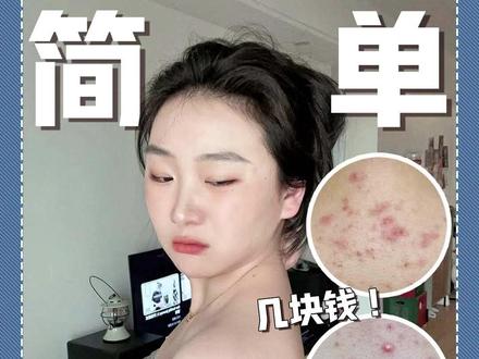 报一丝!背后长痘只要8r轻松解决!#护肤 #后背痘痘 #学生党