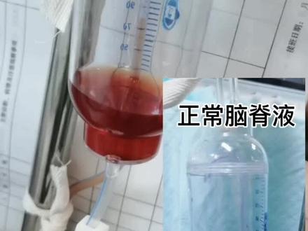 这个视频看一下脑子里红色的“水”,明天的视频来我们来说脑子里的“水”是什么味道的,记得关注…#南方健康