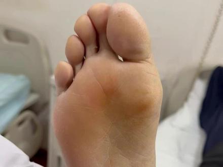 糖尿病足早期信号:脚发凉麻木伴皮肤粗糙 #河南省中医院 #周围血管科李建鹏主任 #抖出健康知识宝藏 #我的年度健康盘点 #糖尿病足