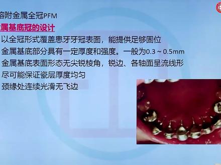 口腔执业含助理-口腔修复学:牙体缺损(金属基底冠的设计)