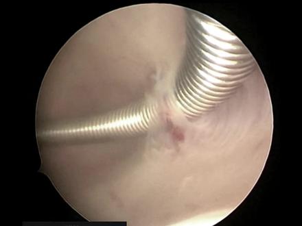 为伟大女性点赞! #宫腔镜 #女性健康