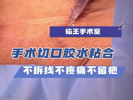 现在的手术切口用胶水粘合,无需拆线,疼痛感不强,还美观不留疤#胶水粘合 #手术切口 #留疤 #鼓楼医院