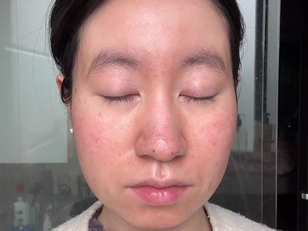 30%水杨+滚针的第二天 破皮后护理思路&跟练版
#水杨酸 #水杨酸护理 #水杨酸翻土 #水杨酸联合滚针 #化学焕肤