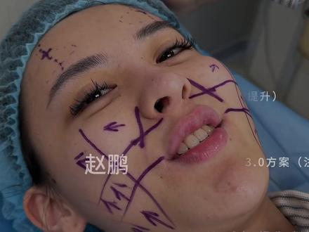 脸垮来上海花75000做面部提升 ,没想到做完竟然这样... 个人效果差异,出镜人已签署相关肖像授权,此视频不宣导任何风险医疗项目!出镜人已满25周岁!#苹果肌下垂#法令纹怎么消除#面部提升#抗衰老#变美