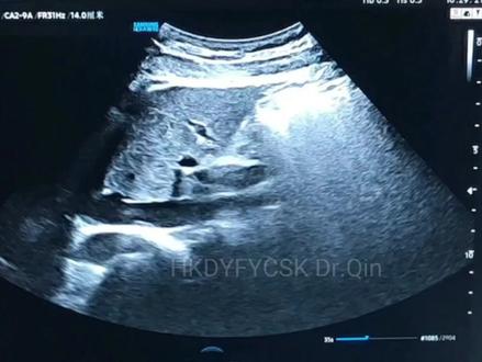 #超声影像 #即兴分享学生问题##医路前行 #每天进步一点点 #即兴边做边讲不足之处望同道指正 @抖音小助手