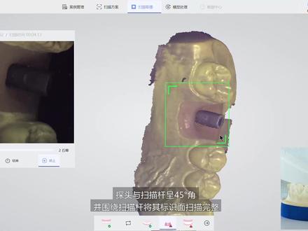 频泰口扫教学视频~3(下颌种植扫描)