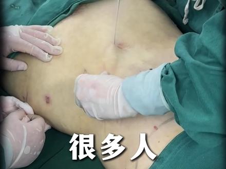 吸脂疼哇哇叫?曹教授是怎么避免疼痛感的#吸脂#脂肪#博士 #上海九院曹卫刚