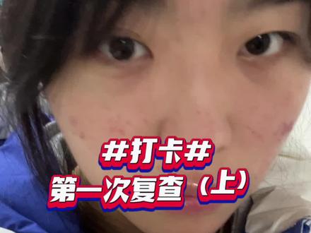 吃💊一个月第一次复查#祛痘 #拯救痘痘肌 #异维a酸软胶囊