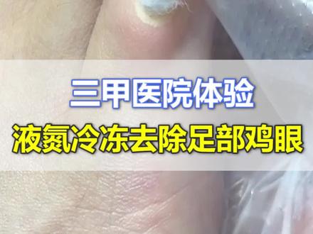鸡眼可以到医院选择了冷冻处理,但是要避免挤压,否则还会复发噢! #樊哥撩皮肤 #鸡眼 #科普