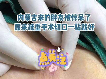 #医学科普 伤口免缝合,胶水直接粘,远道而来的内蒙古胖友感叹到,#减重手术 #减肥 #袖状胃手术 是真正意义上的微创手术。