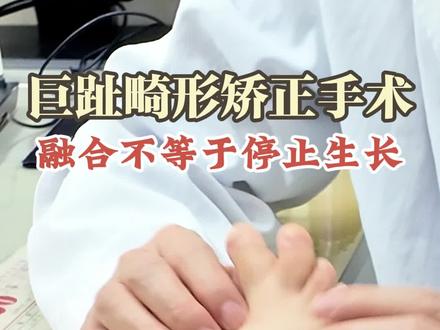 巨趾畸形矫正 #脚趾 #畸形 #手术 #医学科普