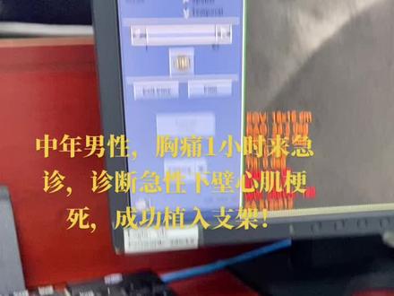 半夜两点来出急诊!患者中年男性,胸痛1小时住院,急性心肌梗死,LCX次全闭塞,成功植入支架1枚#急性心肌梗死