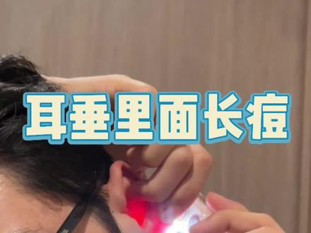 耳垂里面长痘,有硬块。该如何解决#护肤 #耳朵长痘 #痘痘 #护肤 #祛痘