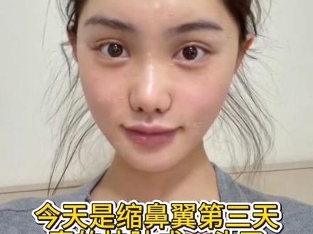 缩👃第二天打卡#缩鼻翼#打卡#精致女人