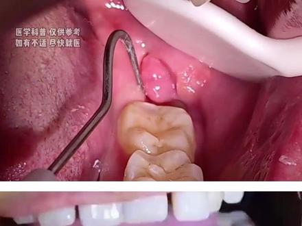 嘴巴出现这3种信号,可能是癌症预警#癌症 #涨知识 #抖出健康知识宝藏 #医学科普 #我的年度健康盘点