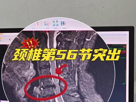 颈椎5/6节突出,硬脊膜受压怎么办? #颈椎病 #硬脊膜 #医学科普 #医者仁心