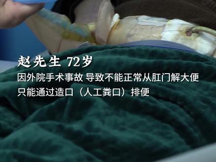 你知道人工造口是什么吗?永久性造口...
#便秘科蓝医生 #造口 #肛肠健康 #拉粑粑 #dou #医学科普