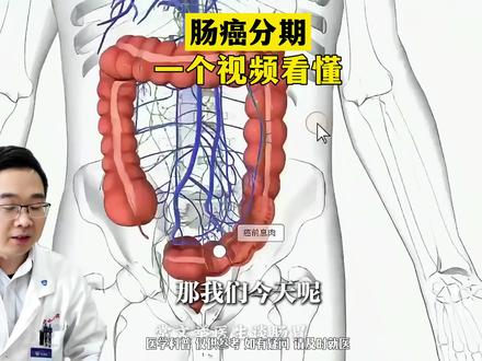 肠癌分期,一个视频看懂!#肠癌 #抖出健康知识宝藏 #3d #医学科普#3d医学动画
