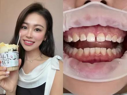 牙齿贴面干货分享 价格|磨牙|术后体验 #牙齿贴面 #牙齿美容 #牙贴面 #牙贴面前后对比照 #慢慢变美