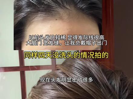 第一次拍,熬夜剪辑好了,希望能对大家有用🫶
#养发心得 #自媒体新人 #真实生活分享计划 #米诺地尔 #拯救发际线