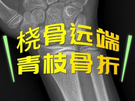 #骨科 #医学影像 #青枝骨折 #桡骨远端骨折 挂羊头卖狗肉的桡骨远端青枝骨折一例
