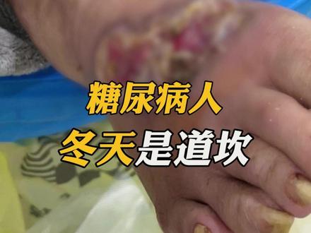 又遇到了一例患有糖尿病的病人,脚部被烫伤,冬天大家要注意了 #烧烫伤专家王新刚#抖出健康知识宝藏#我的年度健康盘点#烫伤#糖尿病遇到烫伤