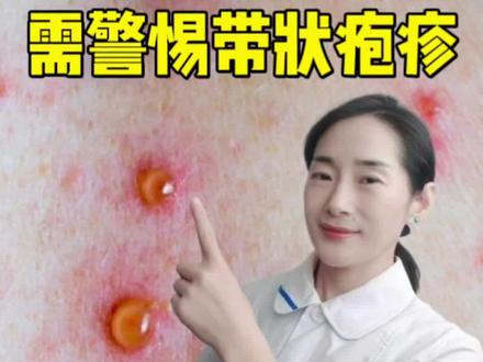 带状疱疹,俗称蛇缠身,号称“天下第一痛”,高血糖人群需警惕!#带状疱疹 #糖尿病 #抖出健康知识宝藏 #我的年度健康盘点 #健康科普