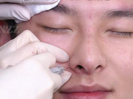 小剂量撑起鼻小柱,缩窄大鼻头 #鼻翼缩小 #大鼻头 #男生鼻子 #塌鼻子 #do鼻