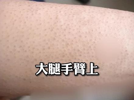 去鸡皮肤的详细方案,你也有的话别错过#科普 #鸡皮肤 #毛囊角化症