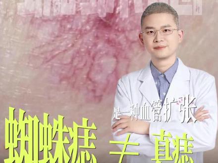 🔴身上小红点是什么?
✅蜘蛛痣 ≠ 真痣,是血管扩张 ✅按压中心褪色
✅好发:面部、颈部、前胸
✅多个反复出现 → 查肝
#蜘蛛痣#重庆市妇幼保健院甘立强教授#甘立强#皮肤和医学美容科#血管扩张