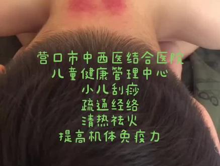 儿童刮痧,吸痧。疏通经络,清热祛火,提高机体免疫力,