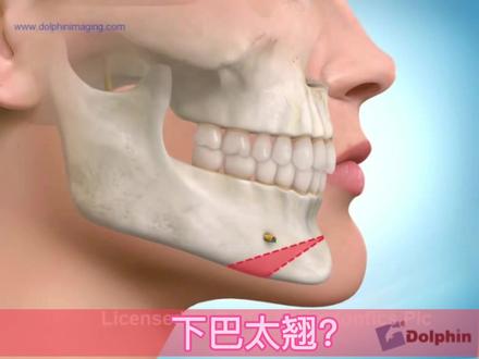 下巴太长、太翘?有办法。#医学科普 #口腔健康