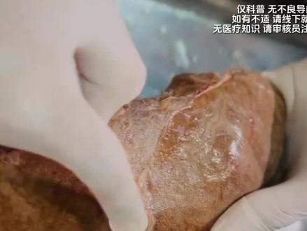 熬夜后的肝脏变化有多大? #涨知识 #科普