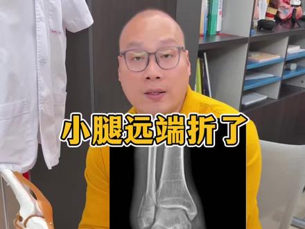 小腿远端这个位置,只是腓骨折了,你觉得严重吗? 主要的承重骨是胫骨,腓骨折了,胫骨也没脱位,通过训练早点走路还是比较容易的。#骨折康复