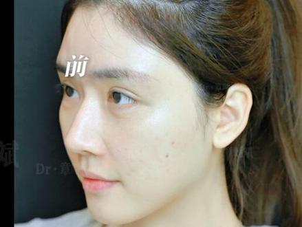 三个点位从干瘪嘴到微笑饱满唇~无痛微笑唇来咯
#成都章哺斌 #章哺斌无痛注射 #成都热点 #微笑唇 #变美逆袭