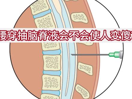 腰穿抽脑脊液会不会使人变傻?