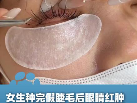 2月10日(采访)安徽合肥,女生种完假睫毛后眼睛红肿 过敏严重,“疼得受不了,以为眼睛会瞎”当事人:太吓人了!以后都不敢做了