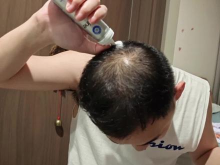 米诺地尔怎么用#米诺地尔 #脱发 #防脱生发