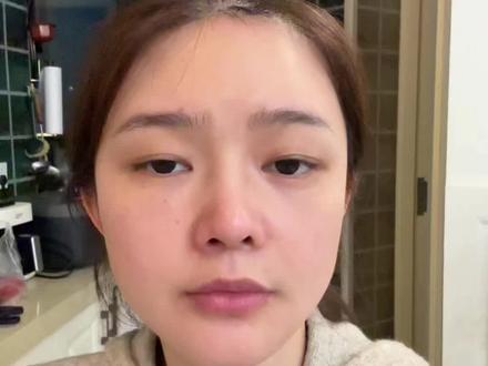 肉毒抬头川字纹。第一次打失败眉压眼飞眉。第二次总结经验再来~ #抬头纹 #川字纹效果太棒了 #眉压眼怎么调整 #飞眉 #肉毒