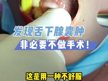 舌下腺囊肿不建议积极手术治疗。如果本身对生活没什么影响,患者从手术中的获益可能微乎其微,而手术却是有代价的...#舌下腺囊肿 #唾液腺囊肿 #粘液囊肿 #腮腺囊肿
