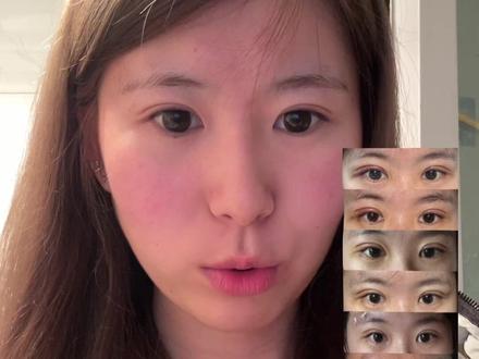 双眼皮护理#割双眼皮#双眼皮恢复记录 #双眼皮护理