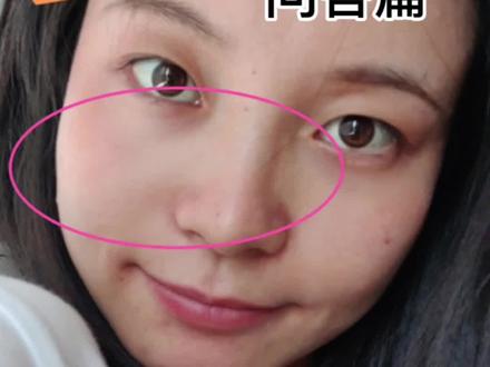 关于项目的问题,统一回复了嗷#印第安纹剥离术 #泪沟 #变美