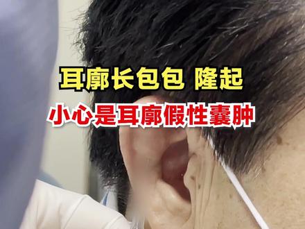 @老林的生活号 耳廓上有隆起的包包,要小心是这个病!