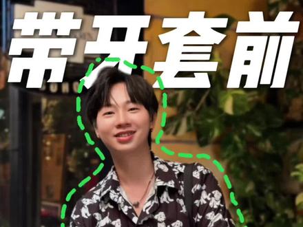 戴牙套避坑指南,新手必看
如果你正琢磨着戴牙套,这念头一旦冒出来恐怕就很难打消了,但我真心建议你看完这篇内容 —— 作为过来人,我必须再劝你一次:戴牙套真的不是拍脑袋就能决定的事。我有看到很多评论区直接 “爆了”:好多人晒出自己的 “牙套脸”,有人刚戴一个月就出现黑三角,甚至有人临到摘牙套时突然遭遇牙龈萎缩,还有牙齿脱矿、满口龋齿、颞下颌关节紊乱的案例…… 各种踩坑经历简直五花八门。
虽然不是每个人都会踩这些雷,但谁也不敢保证自己就是 “天选之子”—— 你能确保遇到的医生不是只想赚快钱的庸医吗?我自己戴牙套5个月了,更关键的是,摘了牙套也不是终点:保持器可能得戴一辈子
不可否认,戴牙套确实能让牙齿变整齐,但这是场 “豪赌”:整好了固然皆大欢喜,可一旦失败呢?你想想,原本只是不整齐的健康牙,最后变成带着黑三角的烂牙,钱花了、时间耗了、罪受了,还得终身戴保持器 —— 这到底值不值?
最后再强调一遍:戴牙套的利弊一定要反复掂量,别把这事想得太理想化,也别觉得 “戴上就能逆袭”。当然,如果你确实需要戴,也别慌到盲目冲去医院 —— 冲动之下做的决定,后悔起来才最难受。
#牙套 #正畸 #矫正 #牙齿 #正畸矫正