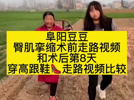 阜阳豆豆臀肌挛缩术前走路视频和术后第8天穿高跟鞋👠走路视频比较#阜阳豆豆#臀肌挛缩#臀肌挛缩症#臀肌挛缩走路#臀肌挛缩走路视频
